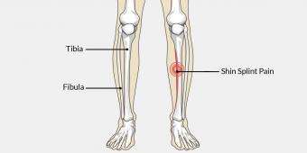 Shin Splints - Treatment & Prevention